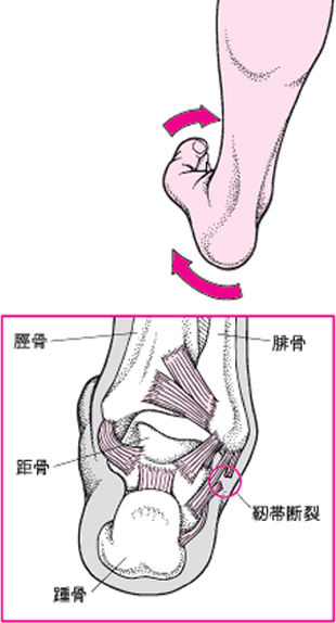 靭帯2.gif